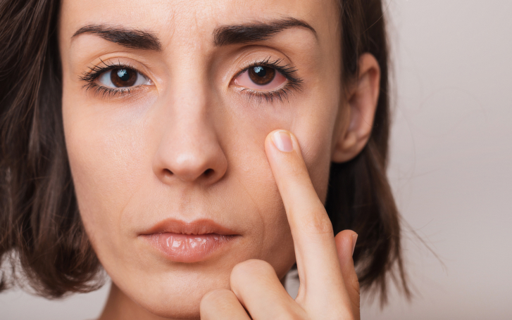 Woman with irritated eyes from blepharoplasty complications