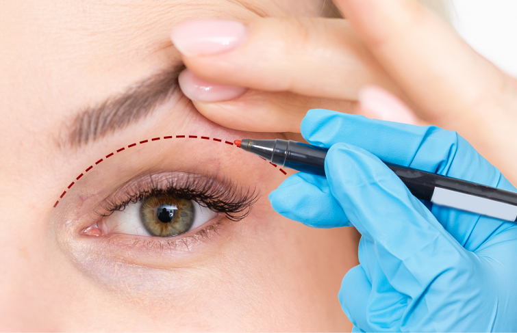 Woman with marking on eyelid before eyelid surgery in Singapore