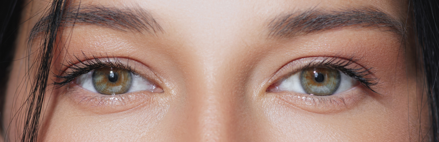 Woman's eyes after ptosis surgery in Singapore with corrected droopy eyelid